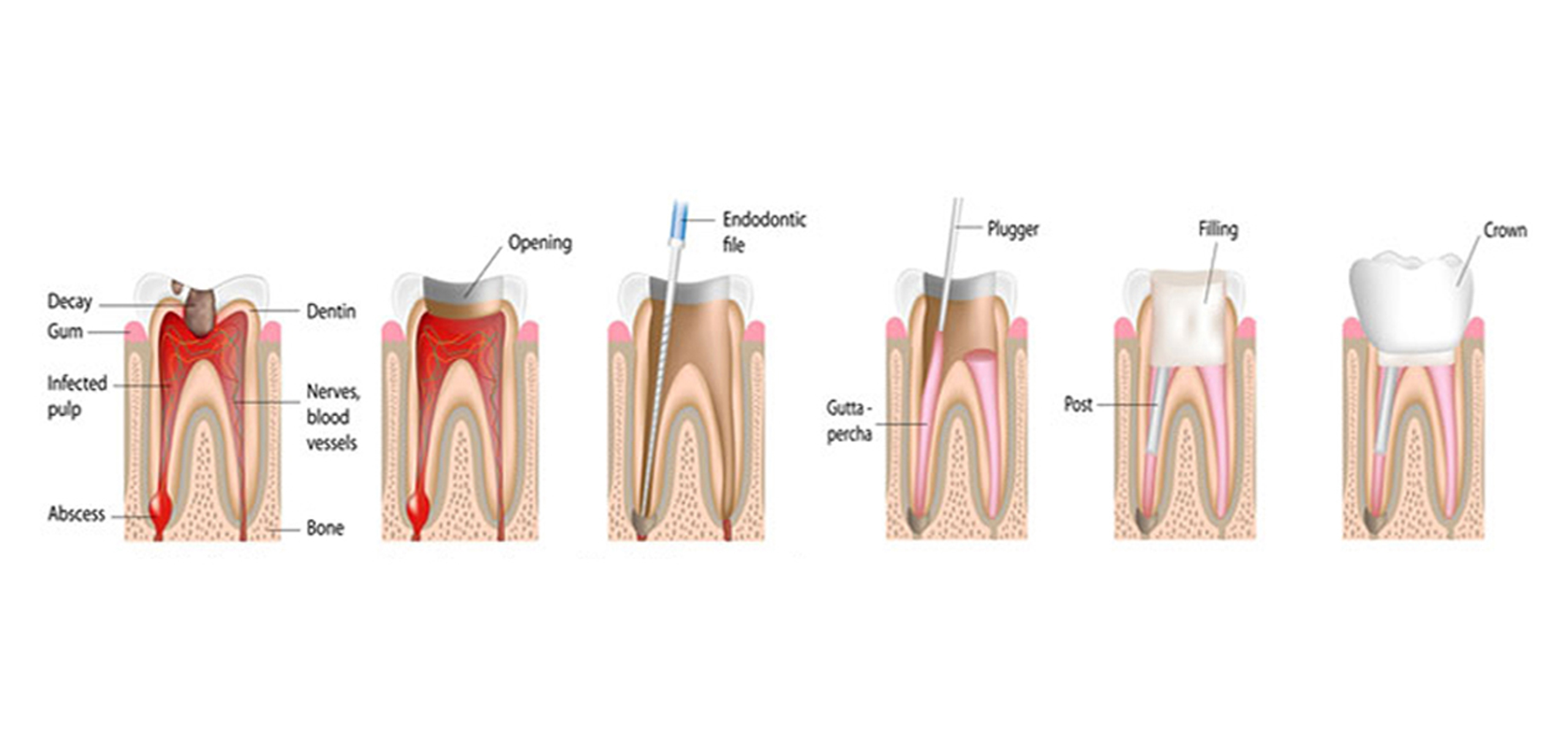 what is root canal treatment for teeth
